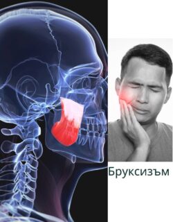 "Негативните последствия за лицето от Бруксизъм"<br> pdf файл